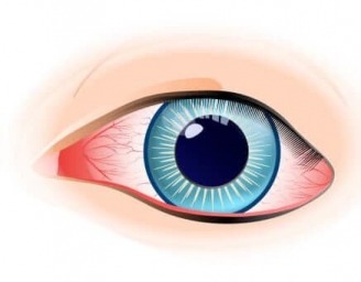 Склерит - Заболевания глаз - Справочник MSD Профессиональная версия