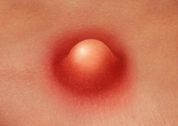 Фурункул на интимном месте - симптомы и лечение у женщин