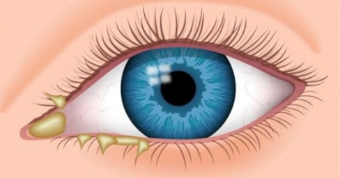 Гнойная инфекция глаза